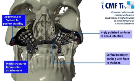 iCMF Ti – Implant Craniomaxilofacial Personalizat din Titan | BoneEasy® - Img 3