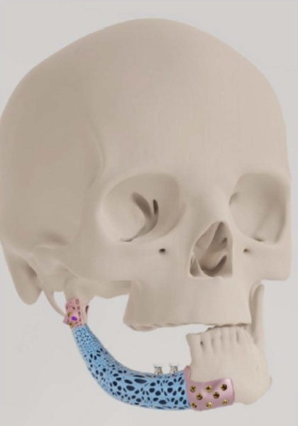 Patient-specific Temporomandibular Joint Endoprosthesis - Img 2