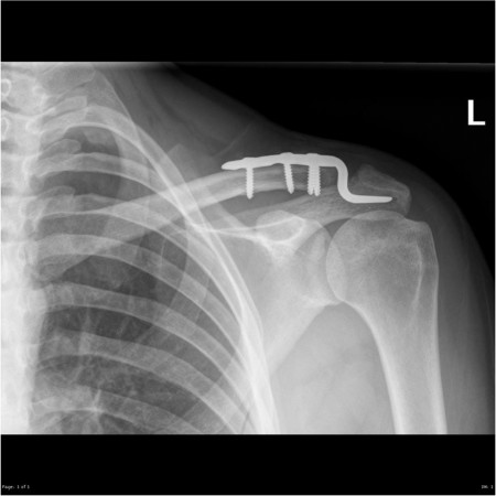 Placa acromioclaviculara poliaxiala pentru osteointeza fracturii de clavicula