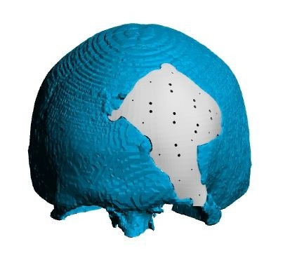 Placa (Cranioplastie), defecte craniene - Img 5