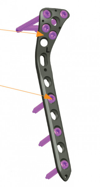 Placa de tibie proximala poliaxiala pentru osteosinteza fracturii de tibie Enlife