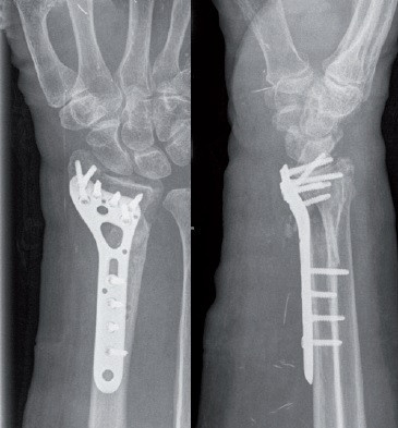 Placa de Radius Distal poliaxiala pentru osteointeza fracturii de radius
