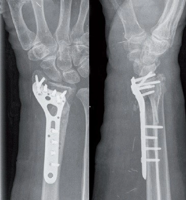 Placa de Radius Distal poliaxiala pentru osteointeza fracturii de radius