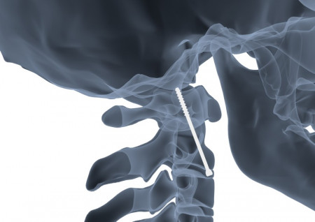 Șurub Canulat ATLAS din Titan – Fixare Odontoidă C2 în Traumă Cervicală - Img 2