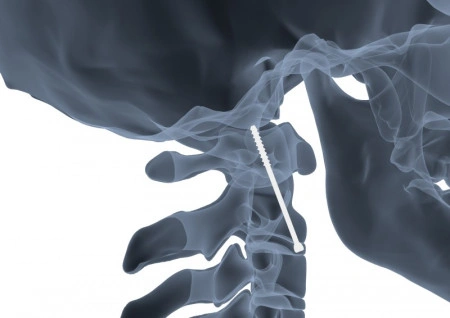 Șurub Canulat ATLAS din Titan – Fixare Odontoidă C2 în Traumă Cervicală - Img 2