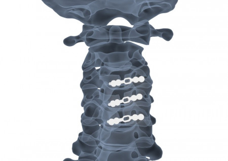 ULTIO LAMINOPLASTY POSTERIOR CERVICAL SPINAL FIXATION SYSTEM - Img 5