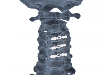 ULTIO LAMINOPLASTY POSTERIOR CERVICAL SPINAL FIXATION SYSTEM - Img 5
