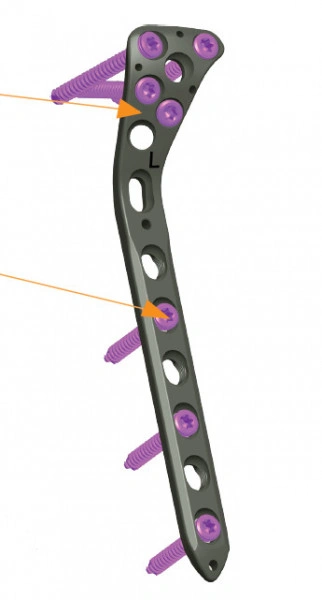 Placa de tibie proximala poliaxiala pentru osteosinteza fracturii de tibie Enlife