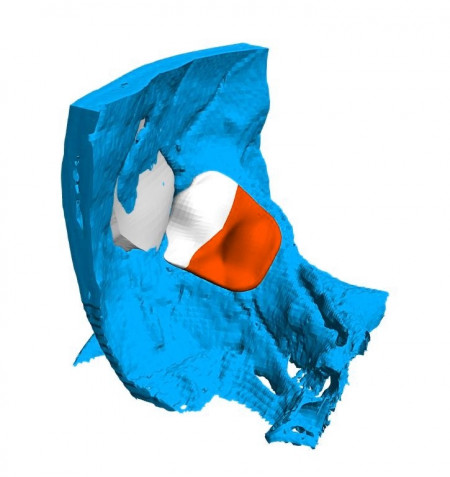 Cranioplasty plate for ENT defects - Img 8