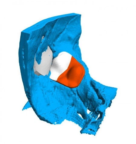 Implant Personalizat pentru Cranioplastie ORL – Soluție 3D Precise de la 3di Germania - Img 8