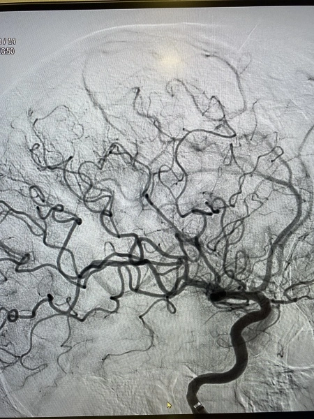 Pictura abstracta: The STROKE ( Accidentul Vascular Cerebral) sau Omul din Copacul Creierului - Img 2