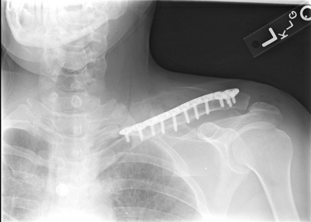 Placa cu extremitate laterala poliaxiala pentru osteointeza fracturii de clavicula