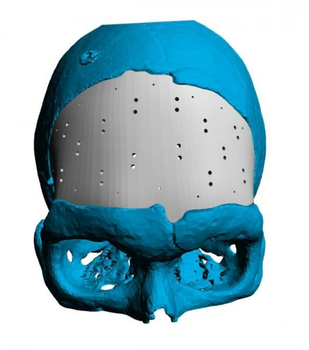 Placa (Cranioplastie), defecte craniene - Img 6