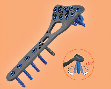 Placa de Radius Distal poliaxiala pentru osteointeza fracturii de radius
