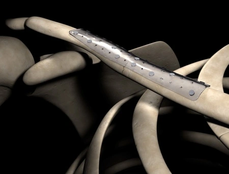 Sistem osteosinteză bioresorbabil Inion Freedom™ | Plăci și șuruburi interblocabile - Img 4