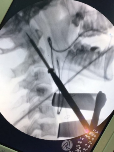 Șurub Canulat ATLAS din Titan – Fixare Odontoidă C2 în Traumă Cervicală - Img 3
