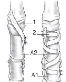 Universal Tendon Spacer U.T.S. – Distanțier Tendinos din Silicon pentru Reconstrucția Tendoanelor Flexorilor și Extensorilor - Img 2