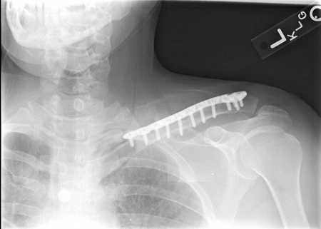 Placa cu extremitate laterala poliaxiala pentru osteointeza fracturii de clavicula