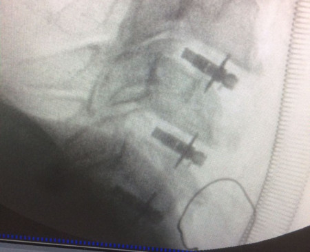ARION EXPANDABLE BLADED CERVICAL PEEK CAGE - Img 2