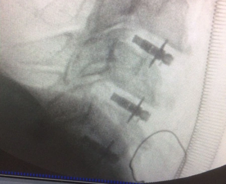 ARION EXPANDABLE BLADED CERVICAL PEEK CAGE - Img 2