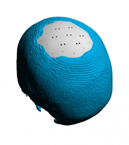 Cranioplasty patient-specific implants - Img 7