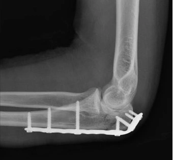 Placa Humerus Proximal poliaxiala pentru osteosinteza fracturii de Olecran