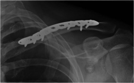 Placa in S poliaxiala pentru osteointeza fracturii de clavicula