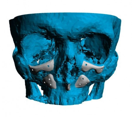 Placă Cranioplastie Personalizată 3D – Implant pentru Defecte BMF | 3di Germania - Img 2