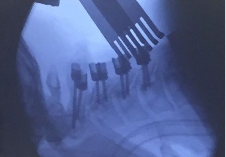 PORTHOS POSTERIOR CERVICAL SPINAL FIXATION SYSTEM - Img 4