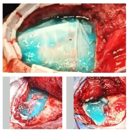 Sigilator de Dura Mater pentru Neurochirurgie Craniană și Spinală - Immiseal® - Img 4
