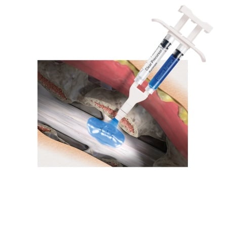 Sigilator de dura pentru chirurgie spinală – DuraSeal® 3 mL
