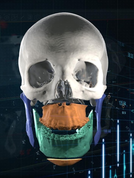 Software pentru planificare chirurgicală cranio-maxilo-facială, chirurgie ortognată – Mimics Enlight CMF (Materialise) - Img 4