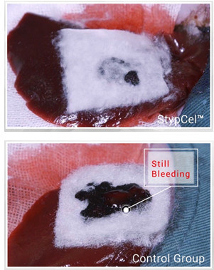Hemostatic StypCel Enlife Solutions