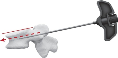 TRIPOD-FIX – Sistem Expansibil Vertebral pentru Fracturi de Compresie | Augmentare cu PMMA - Img 2