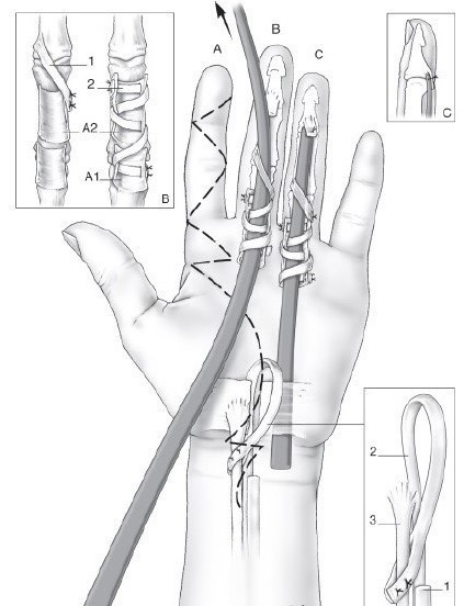Universal Tendon Spacer U.T.S. – Distanțier Tendinos din Silicon pentru Reconstrucția Tendoanelor Flexorilor și Extensorilor - Img 3
