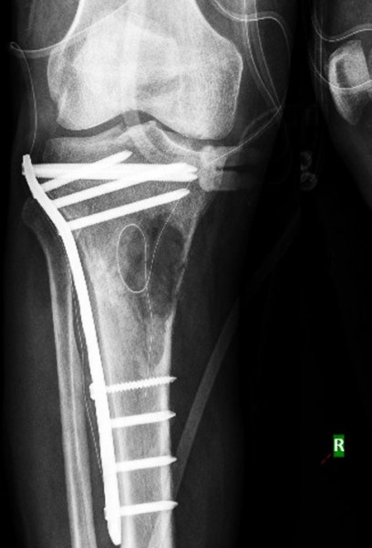 Placa de tibie proximala poliaxiala pentru osteosinteza fracturii de tibie Enlife