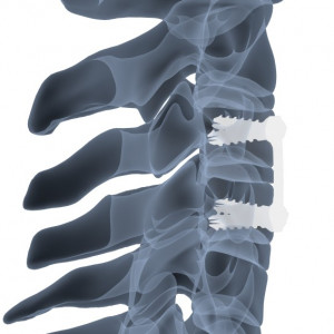 AURA, Suruburi fixare placa cervicala ( AP Trauma)