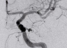 Cateter cu balon PTA pentru tratamentul stenozei intracraniene - NeuroSpeed® - Img 2