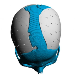 Cranioplasty patient-specific implants - Img 8