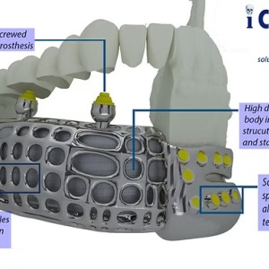 iCMF Ti – Implant Craniomaxilofacial Personalizat din Titan | BoneEasy® - Img 4