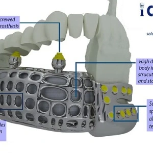 iCMF Ti – Implant Craniomaxilofacial Personalizat din Titan | BoneEasy® - Img 4