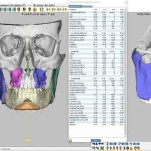 iMIOS – Sistem Personalizat pentru Chirurgie Ortognatică Minim Invazivă | BoneEasy® - Img 3