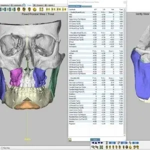 iMIOS – Sistem Personalizat pentru Chirurgie Ortognatică Minim Invazivă | BoneEasy® - Img 3
