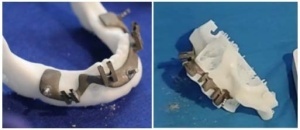 Implant personalizat pentru maxilar, subperiostal – Implantize Compact (Titanium / PEEK) (BoneEasy) - Img 2