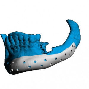 Implant personalizat pentru reconstructia fetei si craniului | 3di Germania
