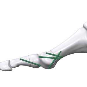 Inion FreedomPin™ – Pin ortopedic bioresorbabil pentru fracturi și osteotomii | Ø1.5–3.2 mm - Img 2