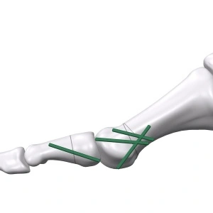 Inion FreedomPin™ – Pin ortopedic bioresorbabil pentru fracturi și osteotomii | Ø1.5–3.2 mm - Img 2
