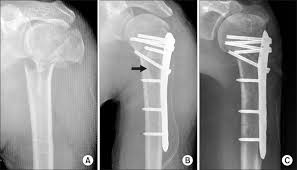 Placa Humerus Proximal poliaxiala pentru osteointeza fracturii de Humerus