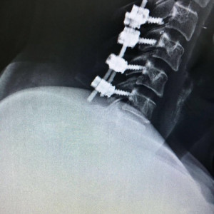 PORTHOS POSTERIOR CERVICAL SPINAL FIXATION SYSTEM - Img 5