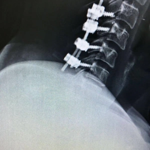 Sistem Șuruburi Poliaxiale PORTHOS | Fixare Coloană Cervicală - Img 5